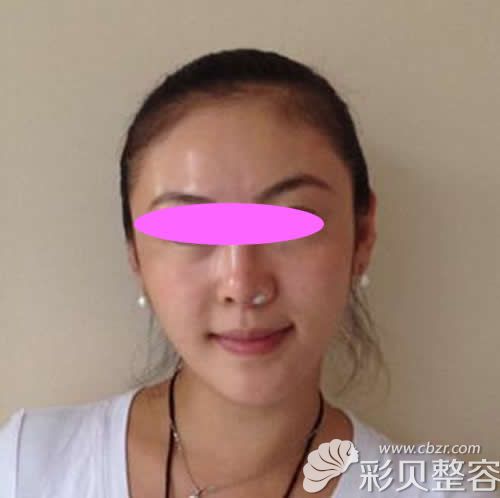 呼和浩特华美张晓刚给我做假体+耳软骨隆鼻术后第3天效果