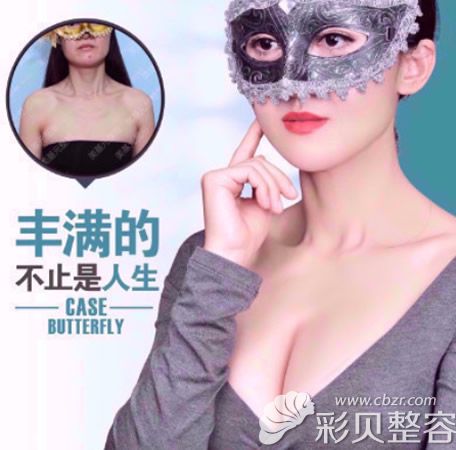 武汉美基元汪富强假体隆胸效果好不好