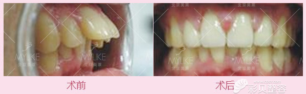 北京美莱医院龅牙矫正前后对比