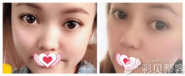 肖玉亮做肋软骨隆鼻+耳软骨垫鼻尖案例效果