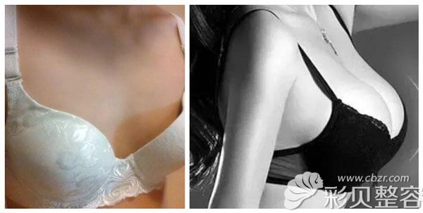 陈宁做自体脂肪丰胸案例效果对比图