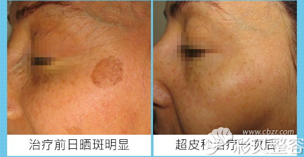 北京美莱整容医院皮肤科激光祛斑对比图