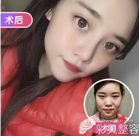 武汉美基元整形汪富强院长黄金支架鼻综合+全脸脂肪填充前后对比照片