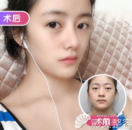 武汉美基元汪富强做隆鼻手术怎么样 这有鼻综合案例+价格表