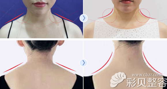 北京美莱医美瘦肩针前后对比