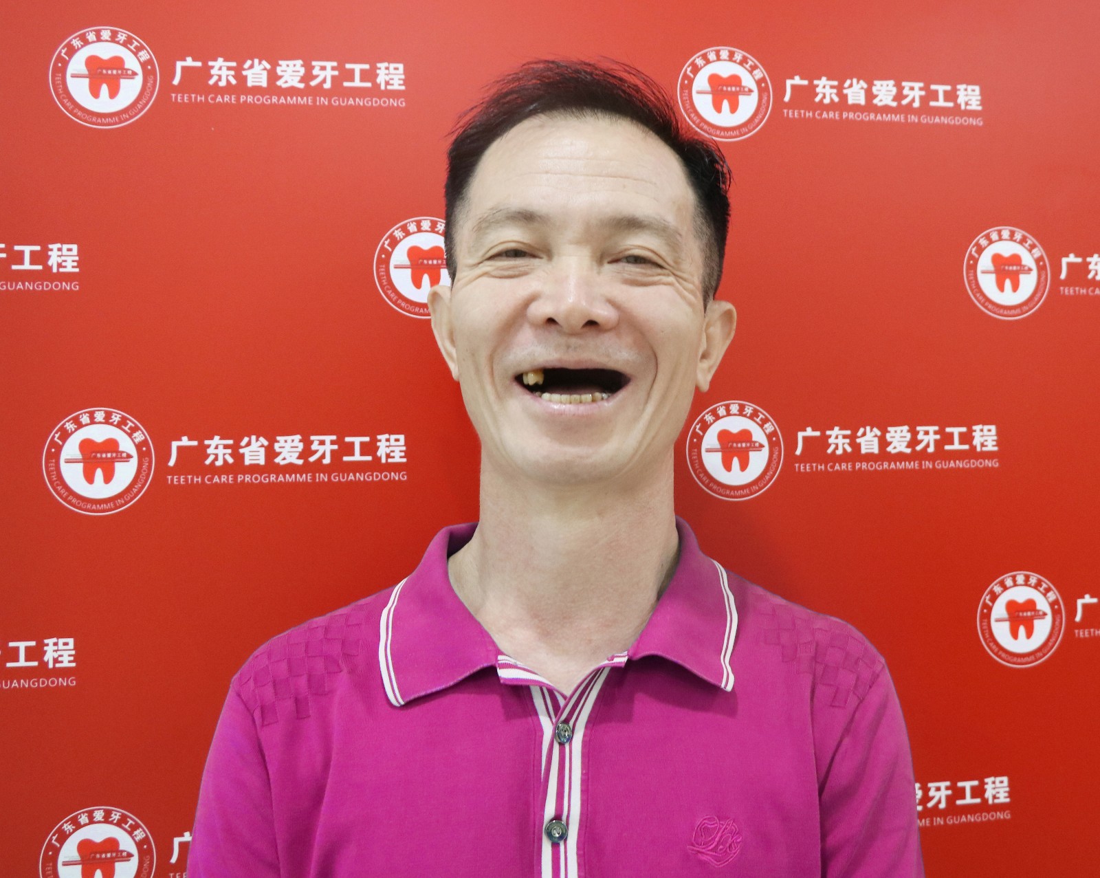 精准“即刻用”种植牙案例二