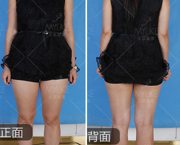 北京美莱王志强大腿吸脂怎么样？我的抽脂瘦腿案例告诉你!