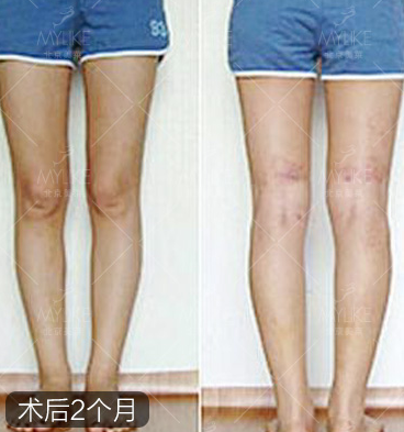 北京美莱王志强大腿吸脂怎么样？我的抽脂瘦腿案例告诉你!