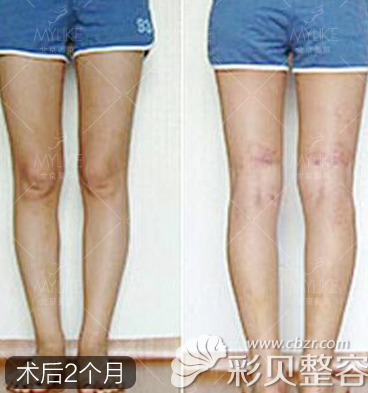 北京美莱王志强腿部抽脂术后2个月