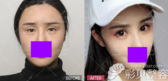 北京美莱刘金华明眸翘睫双眼皮对比