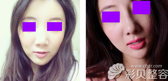 北京美莱整形医生刘金华假体隆鼻效果