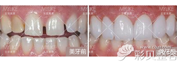 北京美莱口腔医生王凯牙齿修复效果