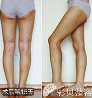 找北京美莱王志强做腿部吸脂塑形第15天