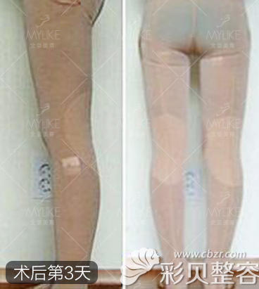 美莱王志强大腿抽脂3天效果