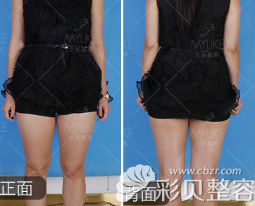 北京美莱整形医院王志强大腿吸脂前