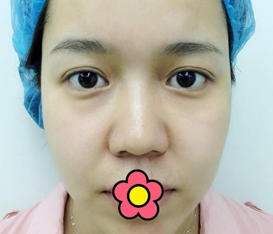 找乌鲁木齐黎美许黎全切双眼皮6个月后 还想做假体隆鼻手术