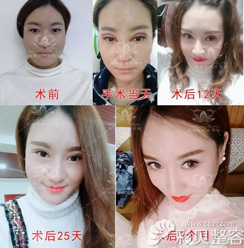悦尚陶文君眼综合手术<span style=