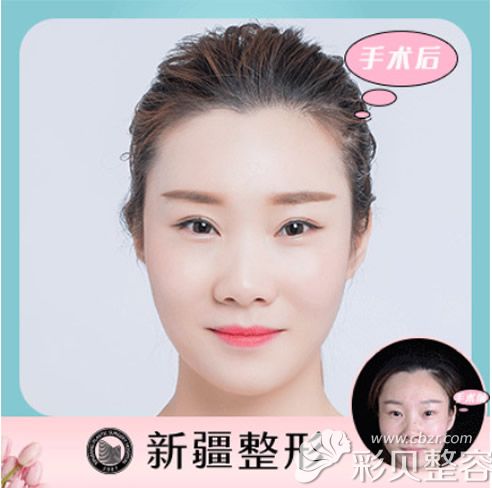 新疆整形医院刘丽娜全切双眼皮<span style=