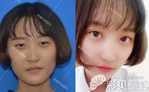 乌鲁木齐华美黄江泊院长切开双眼皮+开眼角<span style=