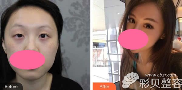 深圳阳光整形李鹏医生做的切开双眼皮一个月效果