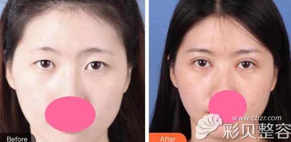 深圳阳光整形李鹏医生做的双眼皮+开眼角眼综合整形效果