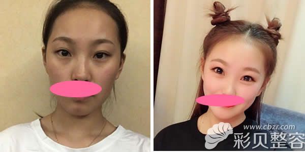 深圳阳光整形李鹏做自体脂肪全脸填充3个月效果