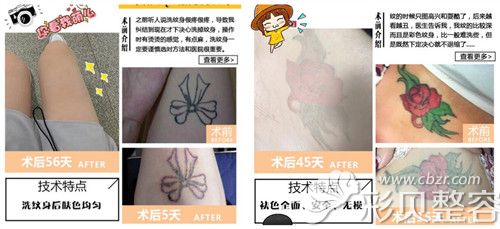 北京玉之光超皮秒洗纹身案例