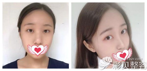 张明欣做肋软骨隆鼻+耳软骨鼻翼缩小术案例效果
