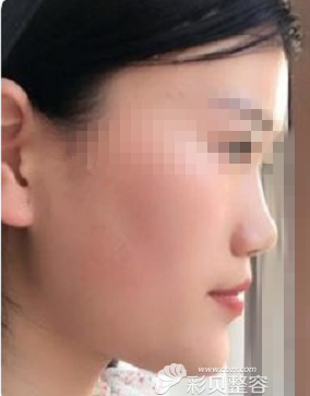 韩国will整形医院做硅胶假体+耳软骨隆鼻手术术前照