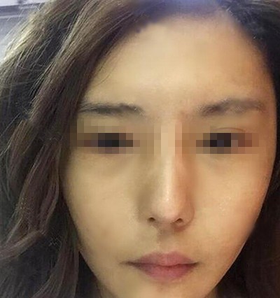 分享我在韩国德社罗伊做面部提升手术一周后的效果