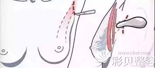 腋下切口的位置及剥离