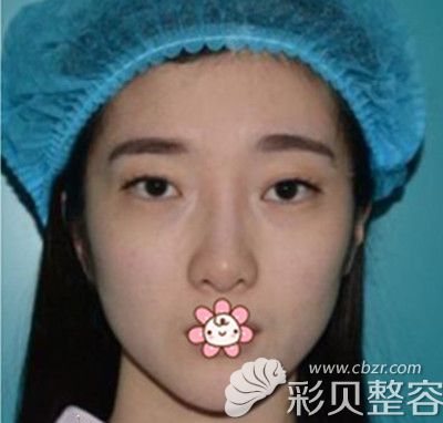 韩国GIO整形医院双眼皮修复术前照