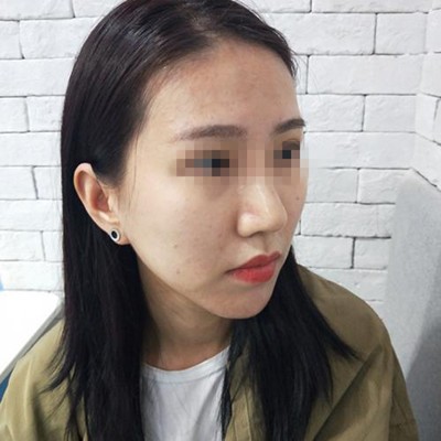 分享一则韩国宝士丽自体脂肪填充全脸真实案例