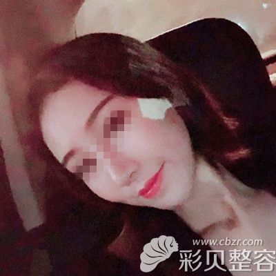 韩国自体脂肪填充全脸术后四个月