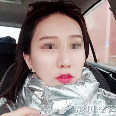 韩国自体脂肪填充全脸术后三个月