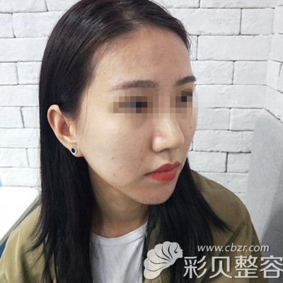 韩国自体脂肪填充全脸术前照