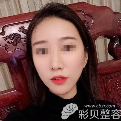 韩国自体脂肪填充全脸术后两个月