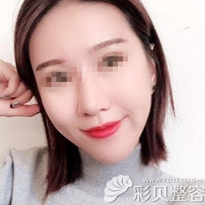 韩国自体脂肪填充全脸术后二十天