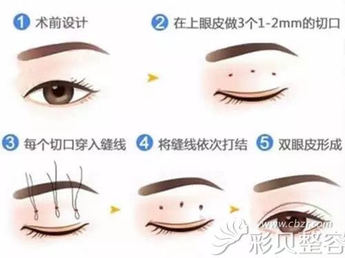 北京海医悦美整形邵桢医生介绍韩式双眼皮的优势