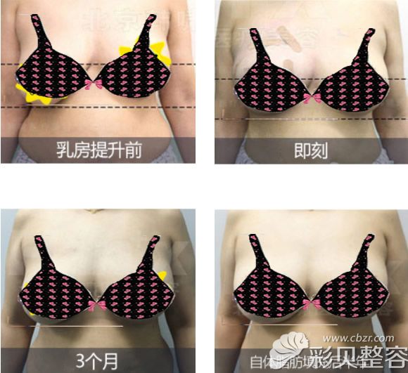 北京韩啸人工韧带提升下垂乳房前后对比照片