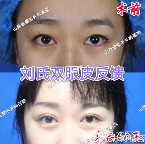 看山西省整形外科医院价格表和太原刘晋元双眼皮隆鼻案例