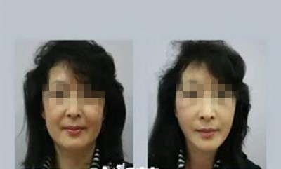 韩国美来可整形医院禹政浩做面部提升术手术真实反馈