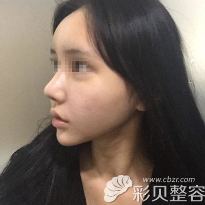 韩国DI整形医院做鼻子修复+全脸脂肪填充手术术后七天