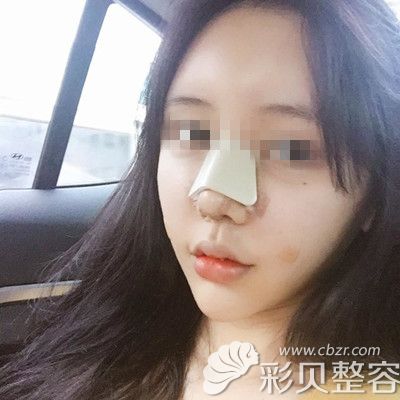韩国DI整形医院做鼻子修复+全脸脂肪填充手术术后第三天