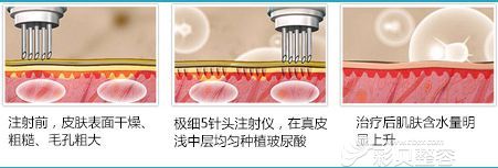 北京奥德丽格于晓昆医生讲水光针的原理