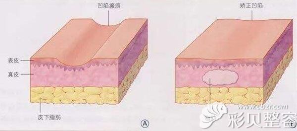 疤痕修复手术费用是多少