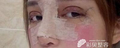 北京万达行医疗整形割双眼皮+隆鼻综合手术后第3天样子