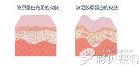 颈部胶原蛋白的流失后皮肤的表现