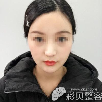 韩国迪美丽做面部吸脂+魔力V线条手术术后十四天