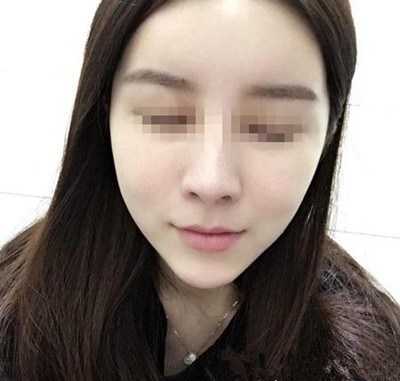 在韩国拉菲安做颧骨缩小+长曲线下颌角术后四个月恢复历程